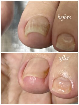 リゼラアンドコー 布施店/ネイルケアで巻き爪予防！