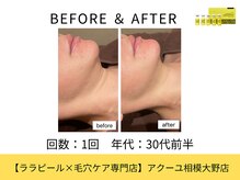 ア クーユ 相模大野店/レモンボトル/二重あご/小顔