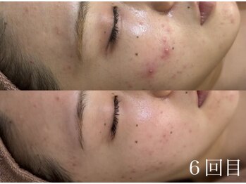 アワピール 天王寺店(AWA PEELL)/ハーブピーリング/毛穴/天王寺