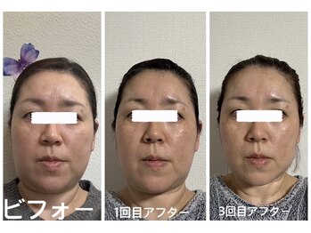 アクアナチュラ(ACQUANATURA)/小顔矯正とリンパマッサージ