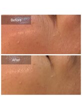 ビビ(VIVI)/目元の小じわに！