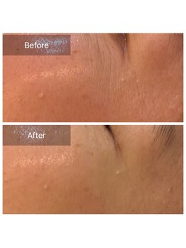 ビビ(VIVI)/目元の小じわに！