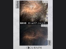 キュライム 熊本(CURAIM)/育毛促進【60代男性】