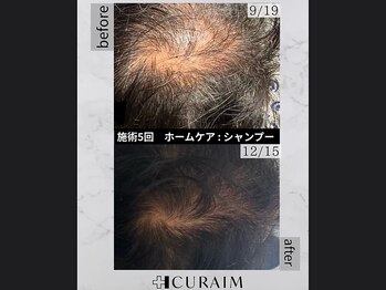 キュライム 熊本(CURAIM)/育毛促進【60代男性】