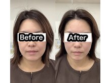 エスピーエー 桂坂(S.P.A)の雰囲気(美容鍼でむくみ解消、トーンアップ)