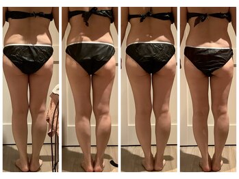 プリヴィエレジェ(privilegie)の写真/上半身or下半身、ハイパーナイフとリンパ流しで集中ケア！理想のボディラインへ◎