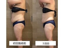 リア(Lia)/キャビテーションの効果☆