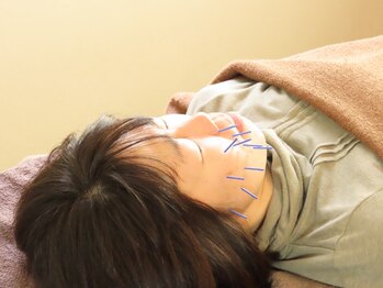 みもざ治療院の写真/刺さない鍼灸/美容鍼灸◆歴17年の経験豊富な国家資格保有者による、あなたのお悩みや痛みに合わせた施術◎