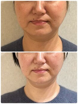 リセス(Recess)/1回で小顔に!