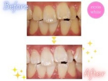 エクシアホワイトニング 西宮北口店/ホワイトニングビフォーアフター