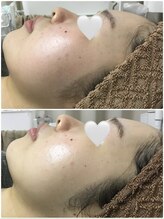 リムーブラボ 藤岡店(Remove Lab.)/大好評☆ハーブピーリング