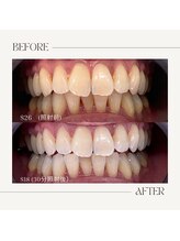 ホワイトニングビューティー 鯖江店(WHITENING BEAUTY)/初回30分照射コース