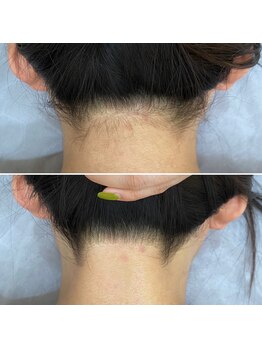 インベスト(INVEST)/うなじ脱毛