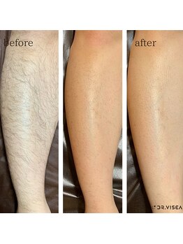 鍼灸整骨院しおん/【メンズ脱毛】