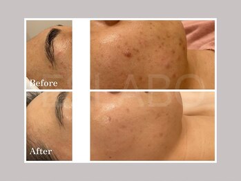 エスラボ オオサカ 心斎橋/毛穴洗浄×ピーリング各種