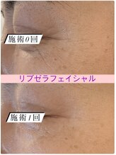 プリュネル(Prunelle)/プラズマシャワー