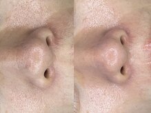 ラヴィオス(RAVIOS)/ハーブピーリング/ララピール