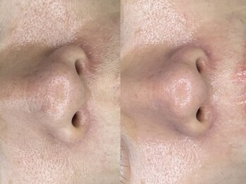 ラヴィオス(RAVIOS)/ハーブピーリング/ララピール