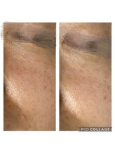 サイ(Sai)/毛穴の大掃除　施術1回目