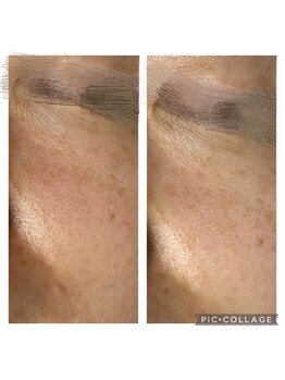 サイ(Sai)/毛穴の大掃除　施術1回目