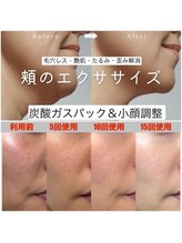 太陽と月/小顔調整＆炭酸ガスパック90分