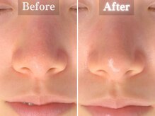 ボーンオム(Born Homme)/毛穴洗浄＋美容液導入：20代女性