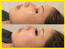 ヴィオール 名古屋栄店(VIOR)/あご肉スッキリ！レモンボトル☆