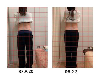 よしの鍼灸整骨院/産後骨盤矯正　　24歳　20回