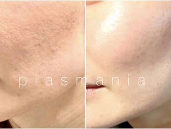 ビジュー(Bijou)の写真/【毛穴開き・黒ずみ改善】プラズマ毛穴ケア　22000→9900