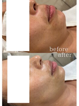 ムゥ(muu)/BBL光フェイシャル