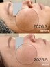 【全世代に人気!紫外線ケア、シミ対策に】高濃度ビタミンC超美白ピーリング☆