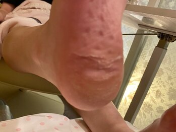 ビサンテ サロン/4)踵の肌質改善,角質育成ケア