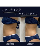 ハリルル 併設 GLケンタ鍼灸整骨院(HARILULU)/筋肉は維持したまま脂肪を落とす