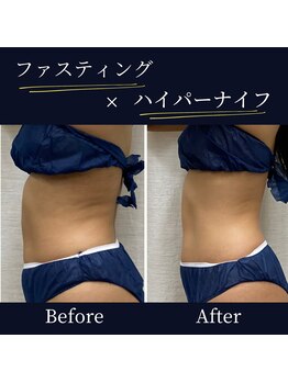 ハリルル 併設 GLケンタ鍼灸整骨院(HARILULU)/筋肉は維持したまま脂肪を落とす