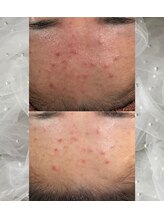 サロンド ユニバース(salon de universe)/20代のニキビケア♪