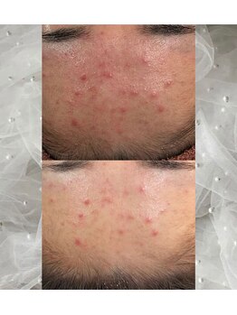 サロンド ユニバース(salon de universe)/20代のニキビケア♪