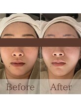 凪眠/小顔リンパフェイシャルの効果24