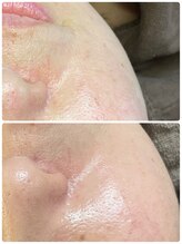 ニコリ(Nicori)/ハーブピーリング