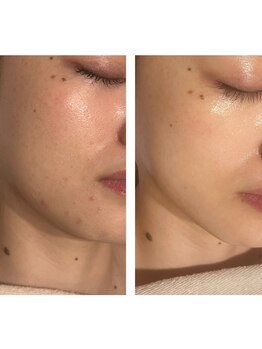 アドビューティ(Add Beauty)/≪プラズマフェイシャル≫