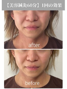 サンクエール 代官山鍼灸院(CINQ AILES)/美容鍼灸　リフトアップ・小顔