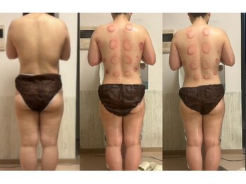 オーシャンブルーム 目黒(OceanBloom)/リンパマッサージハイパーナイフ