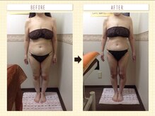 エステティックサロン ピュール ボーテ 東金店/ハイパーナイフ