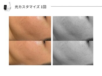 スパレーカ(Spa laka)/光カスタマイズ