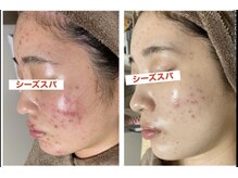 ヘルスアンドビューティー シーズスパ(CSY's SPA)/ハーブピーリングで肌質改善