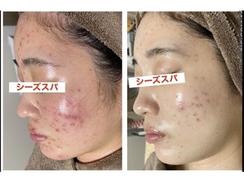 ヘルスアンドビューティー シーズスパ(CSY's SPA)/ハーブピーリングで肌質改善