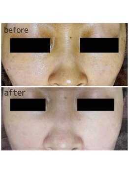 ブランシェ 高岡店 × 椿/シミケア　お客様