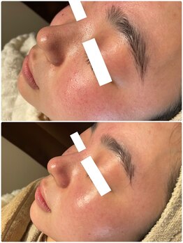 ディオーネ 春日井勝川店(Dione)/毛穴洗浄☆ビフォーアフター