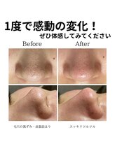 エステ シンセリティー(aesthetic sincerity)/毛穴洗浄9800円→モニター4500円