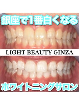 ライトビューティー 銀座店(LightBeauty)/東銀座 ホワイトニング 症例写真