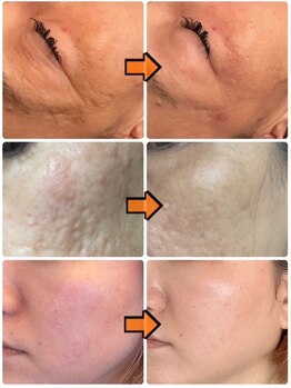 ジョルジオ東京/プラズマフラクショナル